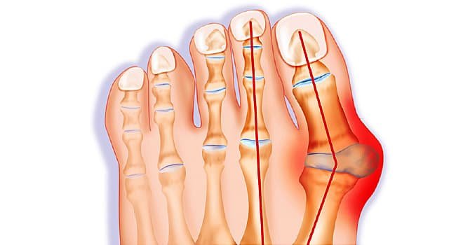 Bunions, Corns, and Calluses What You Should Know